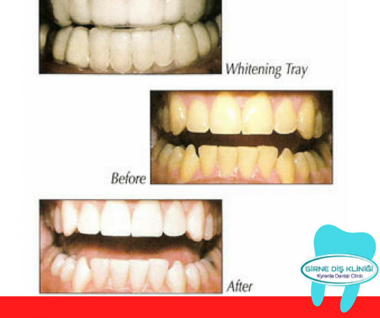 Teeth Whitening - Kyrenia Dental Clinic | Kyrenia, North ...